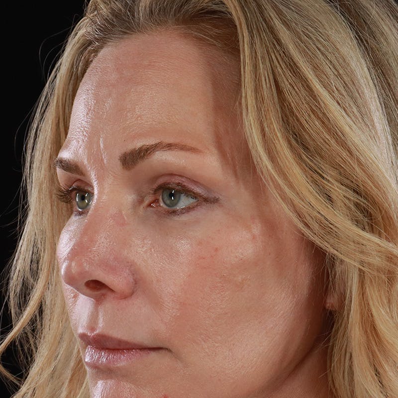 Lower Eyelid Surgery Before & After Gallery - Patient 309752 - Image 12