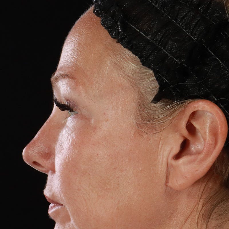 Lower Eyelid Surgery Before & After Gallery - Patient 309752 - Image 13