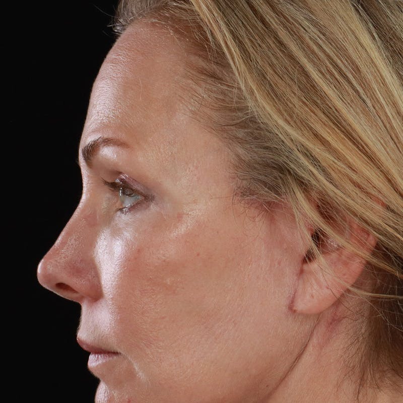 Lower Eyelid Surgery Before & After Gallery - Patient 309752 - Image 14