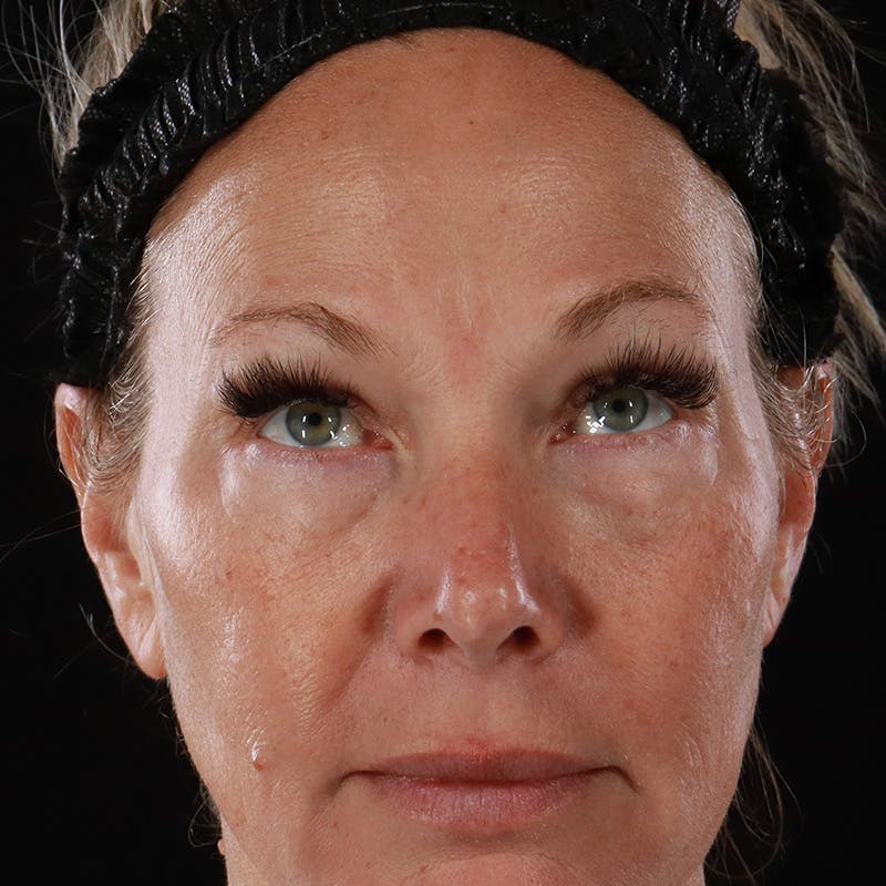 Lower Eyelid Surgery Before & After Gallery - Patient 309752 - Image 3