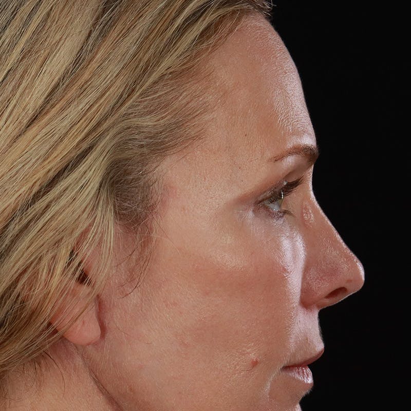 Lower Eyelid Surgery Before & After Gallery - Patient 309752 - Image 10