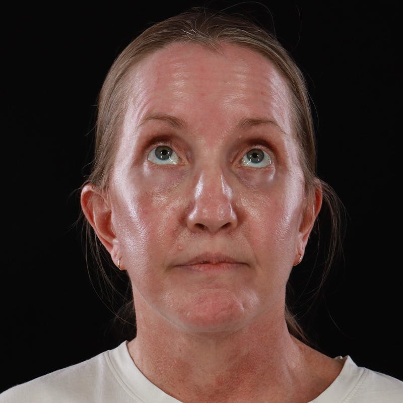 Facelift Before & After Gallery - Patient 190513 - Image 4