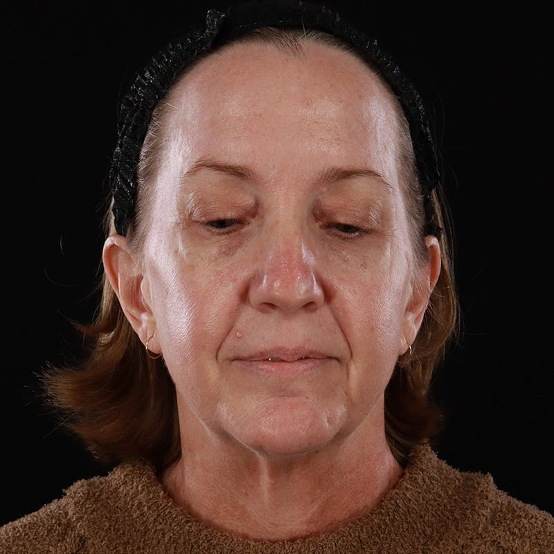 Facelift Before & After Gallery - Patient 190513 - Image 5