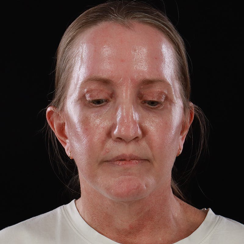 Facelift Before & After Gallery - Patient 190513 - Image 6