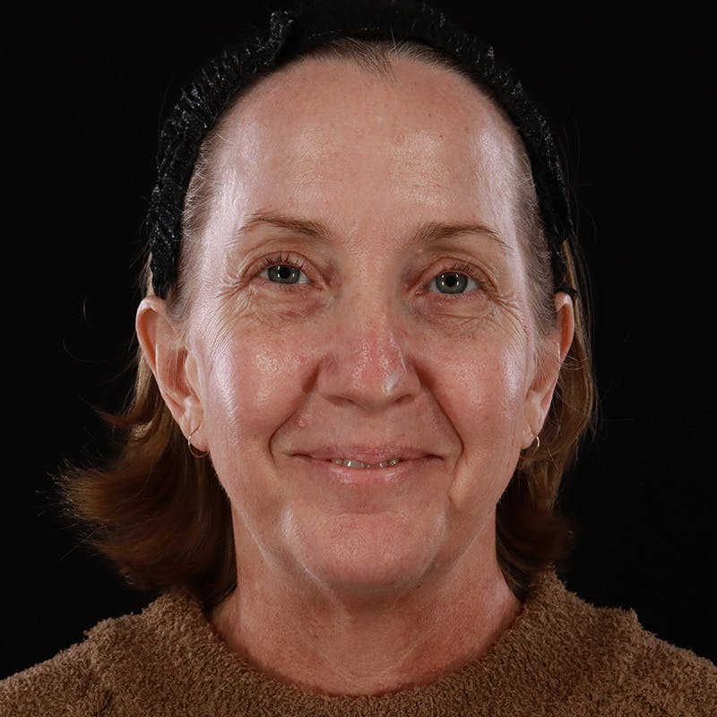 Facelift Before & After Gallery - Patient 190513 - Image 1