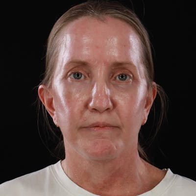 Contour Total Resurfacing Laser Before & After Gallery - Patient 604027 - Image 2