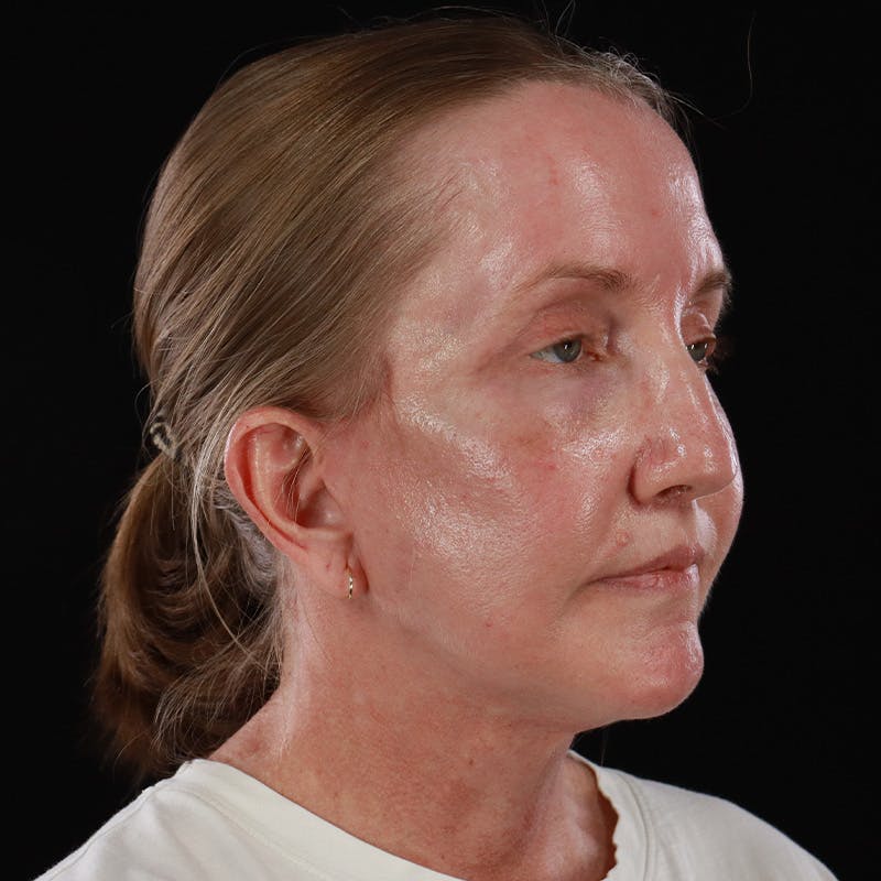 Facelift Before & After Gallery - Patient 190513 - Image 8