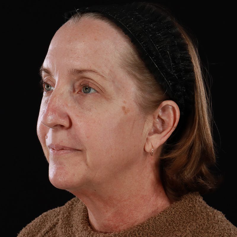 Facelift Before & After Gallery - Patient 190513 - Image 11