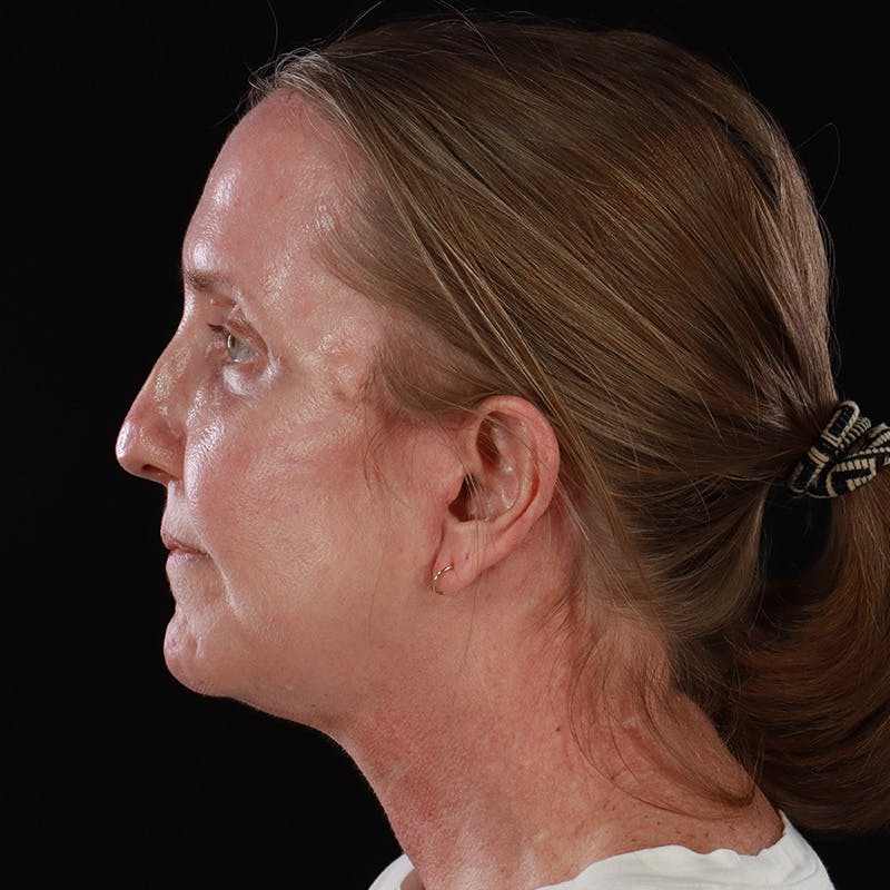 Facelift Before & After Gallery - Patient 190513 - Image 14