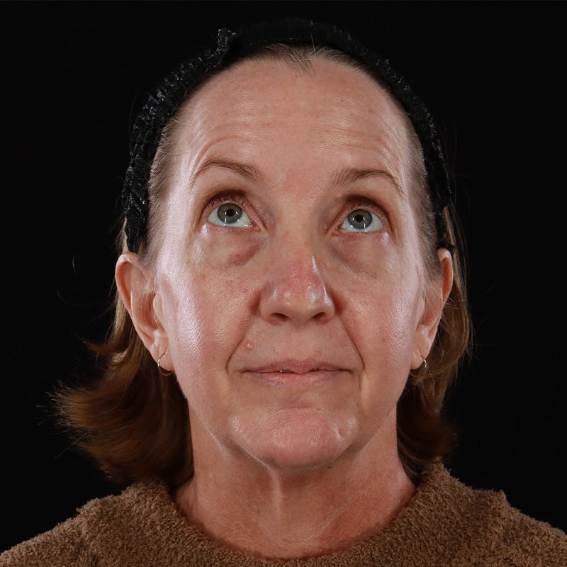 Facelift Before & After Gallery - Patient 190513 - Image 3