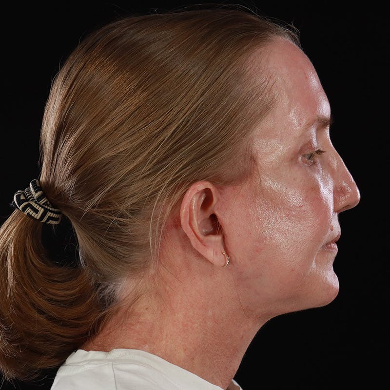 Facelift Before & After Gallery - Patient 190513 - Image 10