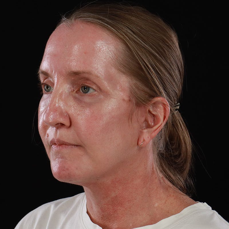 Facelift Before & After Gallery - Patient 190513 - Image 12