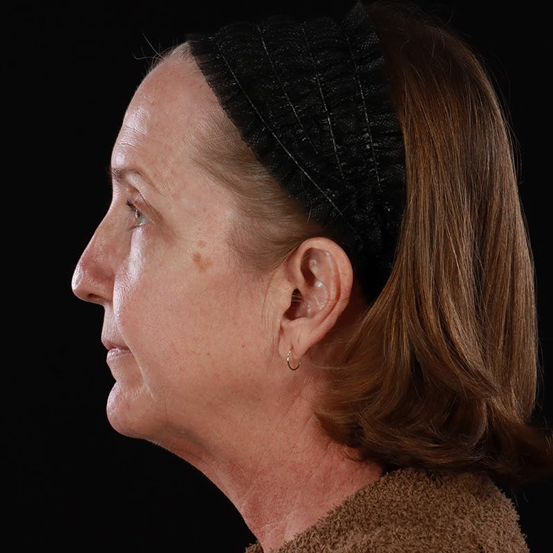 Facelift Before & After Gallery - Patient 190513 - Image 13