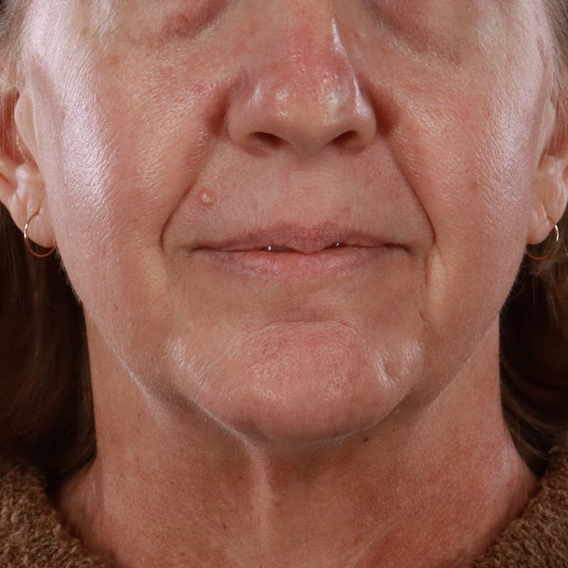 Lip Lift Before & After Gallery - Patient 369180 - Image 1