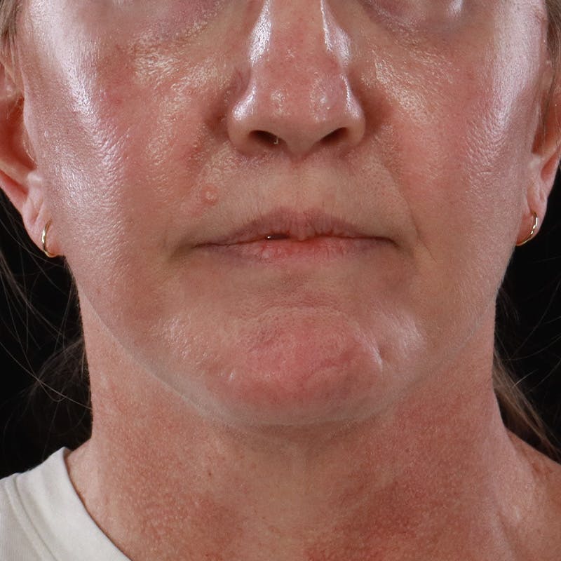 Lip Lift Before & After Gallery - Patient 369180 - Image 2