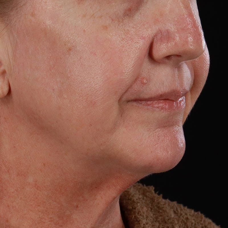 Lip Lift Before & After Gallery - Patient 369180 - Image 3