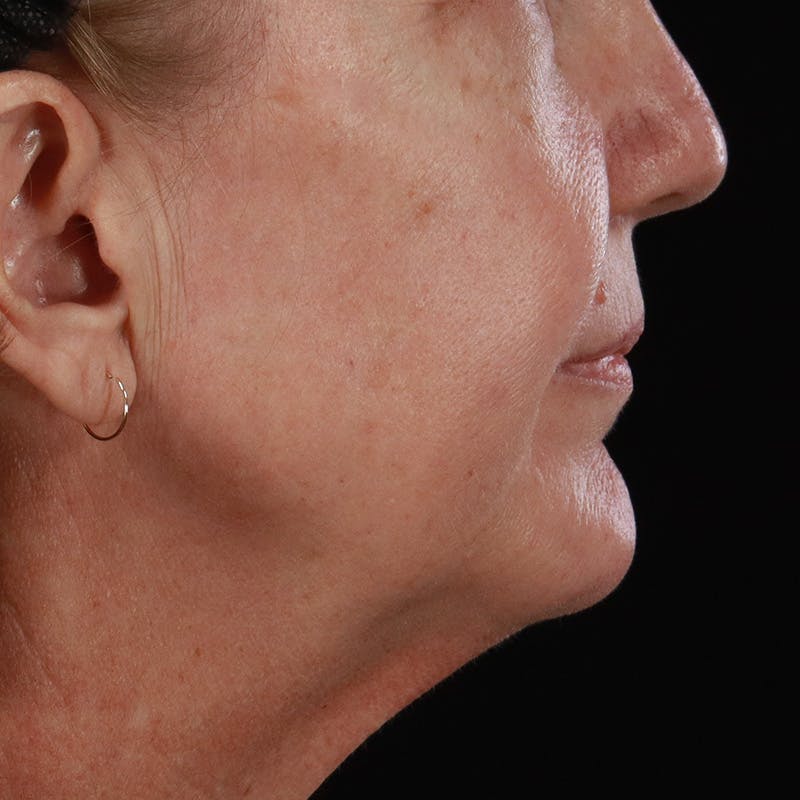 Lip Lift Before & After Gallery - Patient 369180 - Image 5