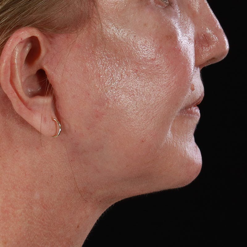 Lip Lift Before & After Gallery - Patient 369180 - Image 6