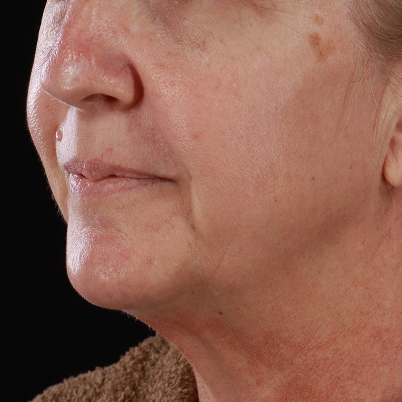 Lip Lift Before & After Gallery - Patient 369180 - Image 7