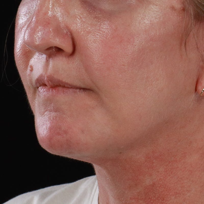 Lip Lift Before & After Gallery - Patient 369180 - Image 8