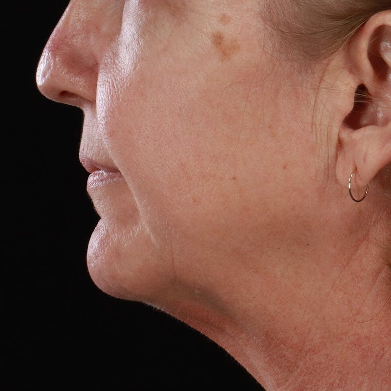 Lip Lift Before & After Gallery - Patient 369180 - Image 9