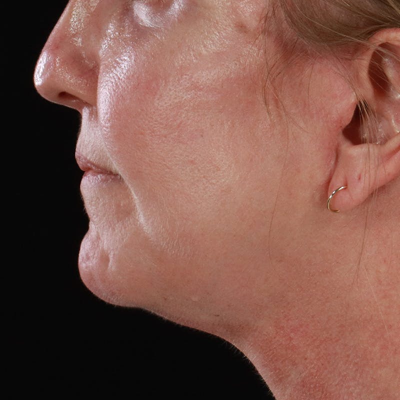 Lip Lift Before & After Gallery - Patient 369180 - Image 10