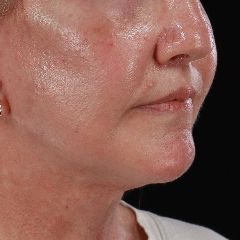 Lip Lift Before & After Gallery - Patient 369180 - Image 4