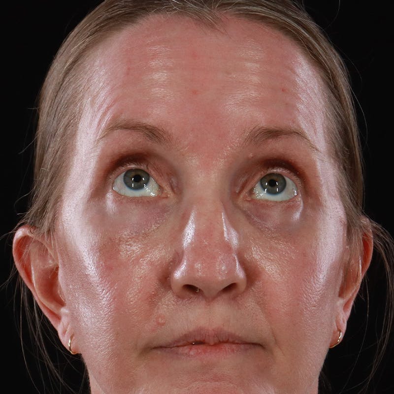 Upper Eyelid Surgery Before & After Gallery - Patient 667280 - Image 4