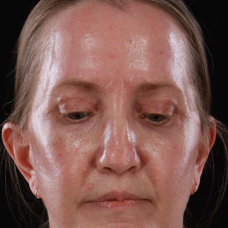 Upper Eyelid Surgery Before & After Gallery - Patient 667280 - Image 6