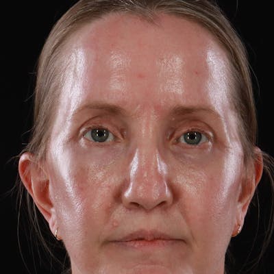 Upper Eyelid Surgery Before & After Gallery - Patient 667280 - Image 2