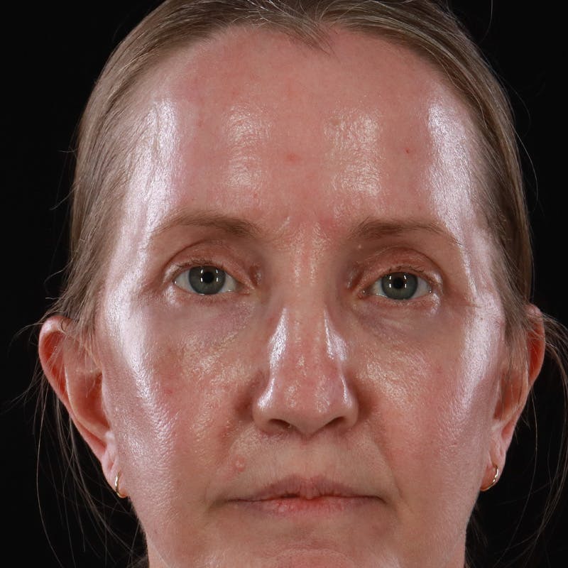 Upper Eyelid Surgery Before & After Gallery - Patient 667280 - Image 2