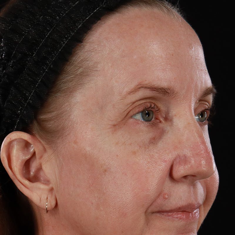 Upper Eyelid Surgery Before & After Gallery - Patient 667280 - Image 7