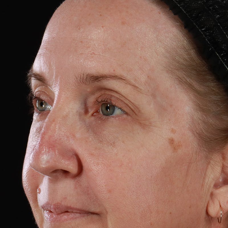 Upper Eyelid Surgery Before & After Gallery - Patient 667280 - Image 11