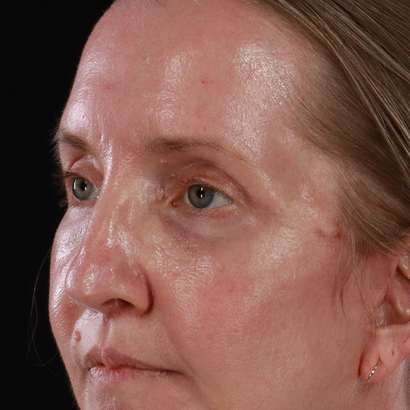 Upper Eyelid Surgery Before & After Gallery - Patient 667280 - Image 12