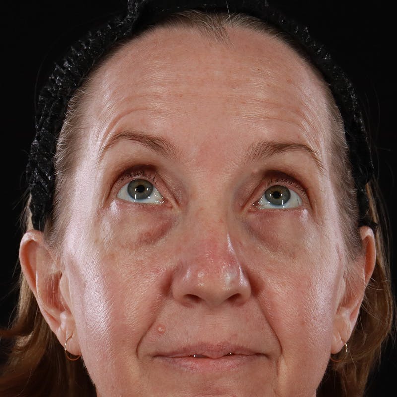 Upper Eyelid Surgery Before & After Gallery - Patient 667280 - Image 3