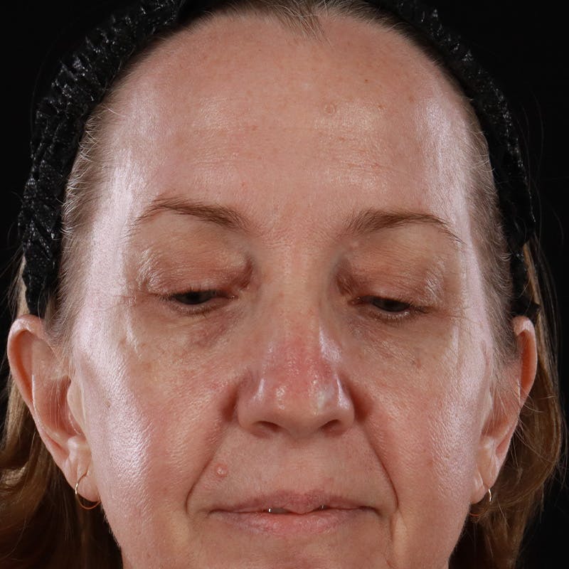 Upper Eyelid Surgery Before & After Gallery - Patient 667280 - Image 5