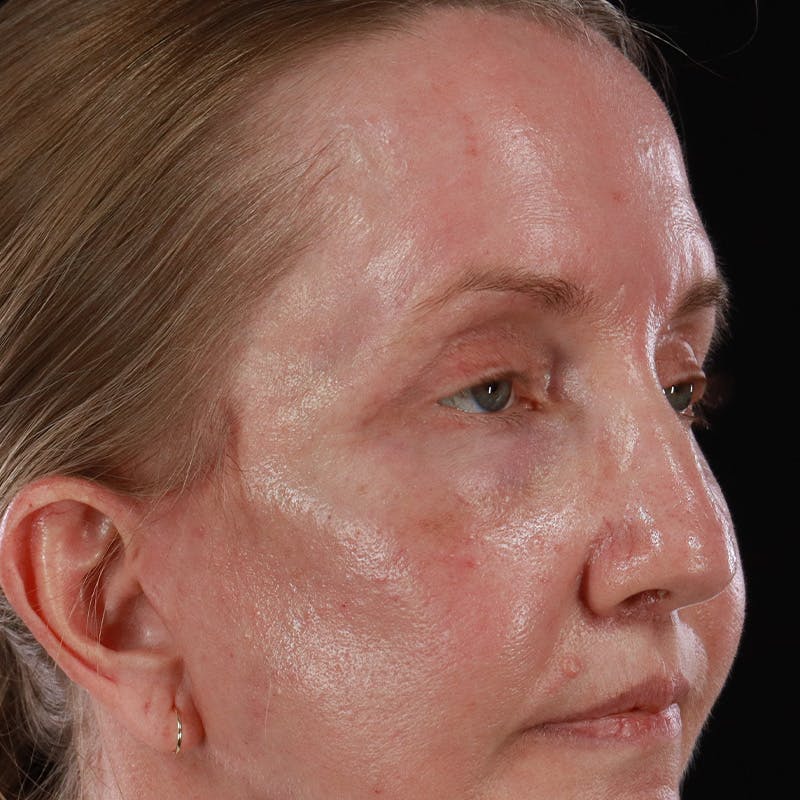 Upper Eyelid Surgery Before & After Gallery - Patient 667280 - Image 8