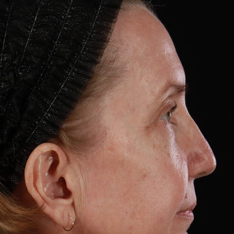 Upper Eyelid Surgery Before & After Gallery - Patient 667280 - Image 9