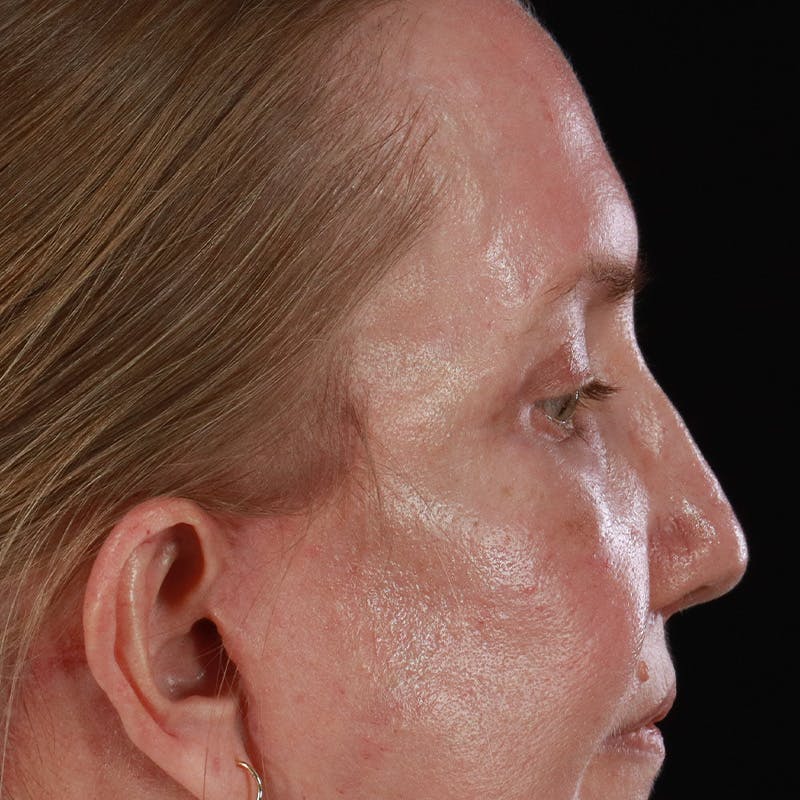 Upper Eyelid Surgery Before & After Gallery - Patient 667280 - Image 10