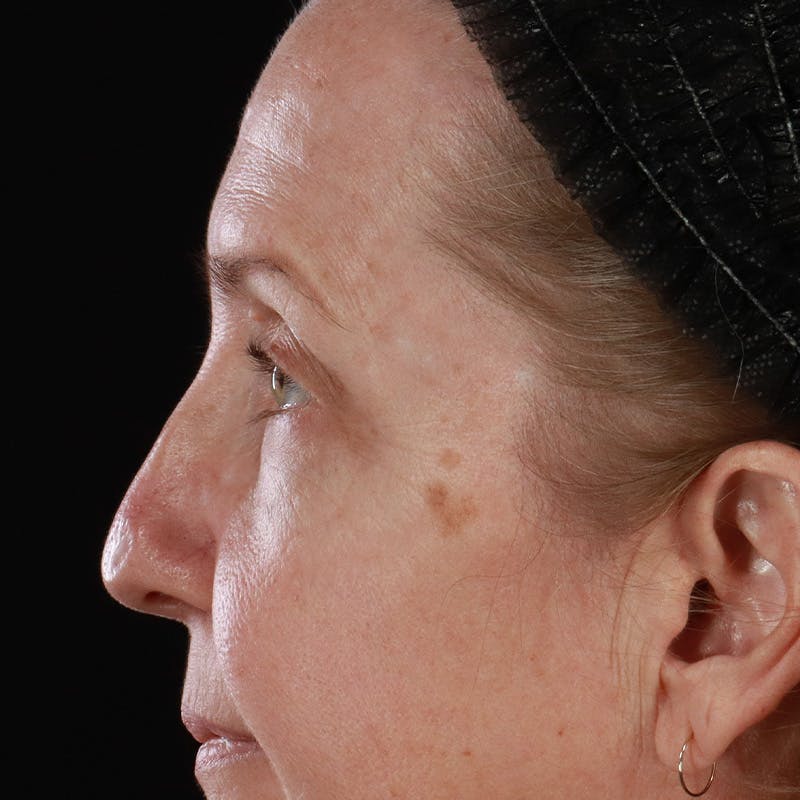 Upper Eyelid Surgery Before & After Gallery - Patient 667280 - Image 13