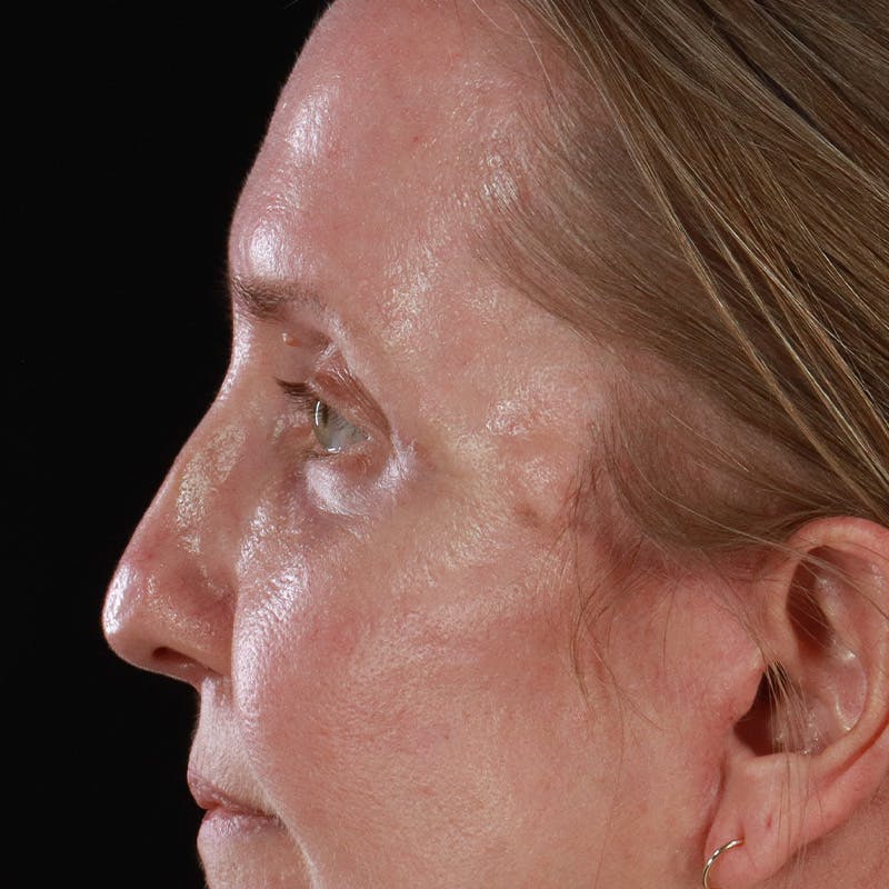 Upper Eyelid Surgery Before & After Gallery - Patient 667280 - Image 14