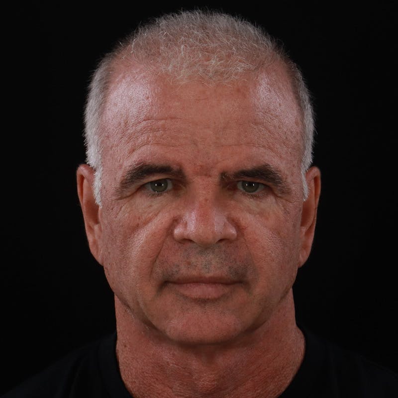 Facelift Before & After Gallery - Patient 424295 - Image 1