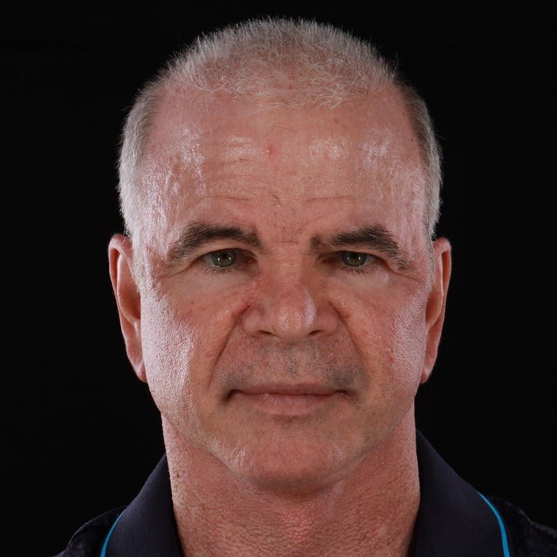 Facelift Before & After Gallery - Patient 424295 - Image 2