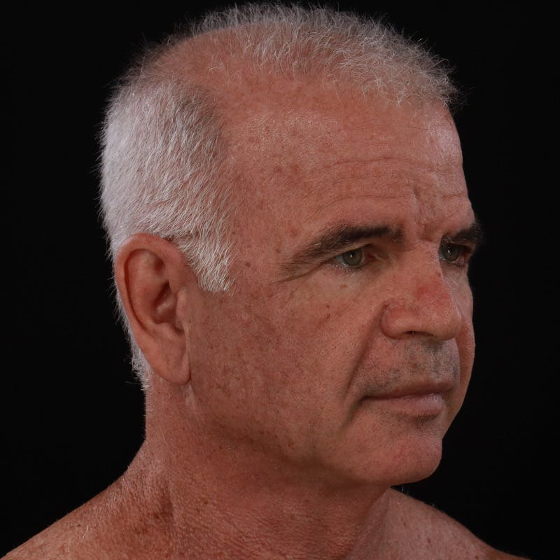 Facelift Before & After Gallery - Patient 424295 - Image 3