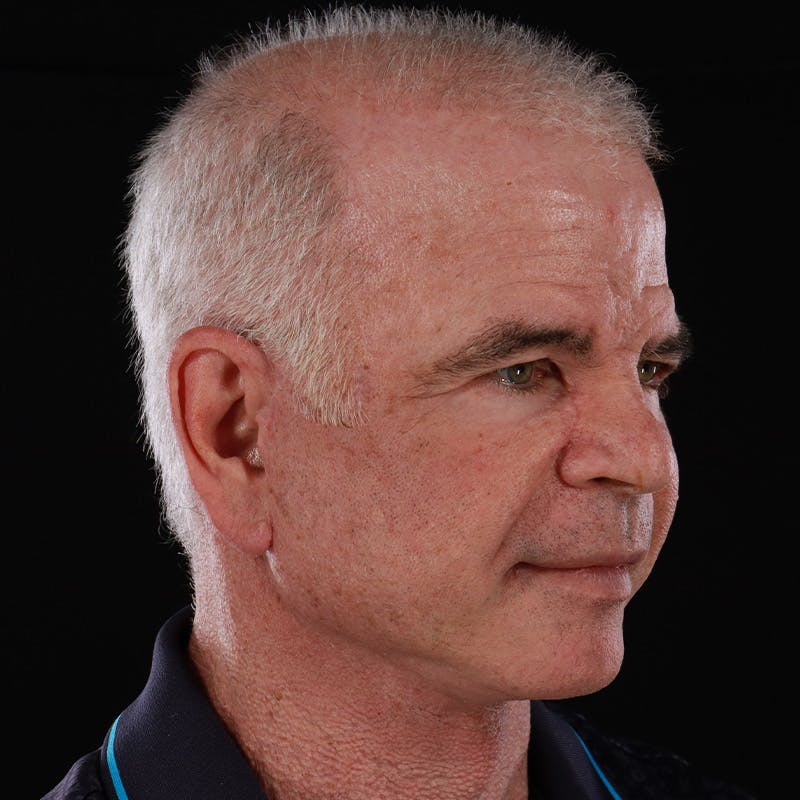 Facelift Before & After Gallery - Patient 424295 - Image 4