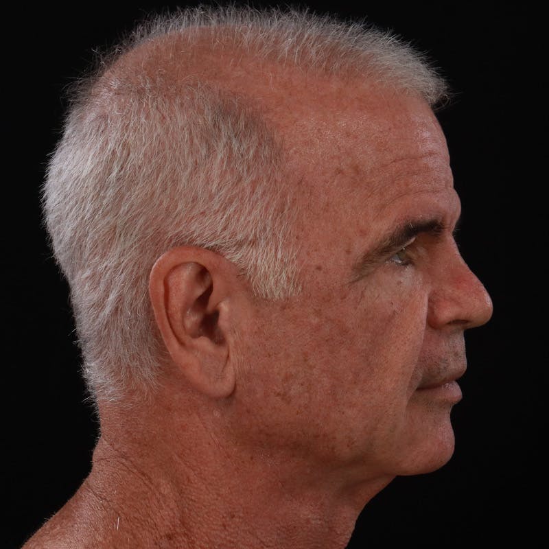Facelift Before & After Gallery - Patient 424295 - Image 5
