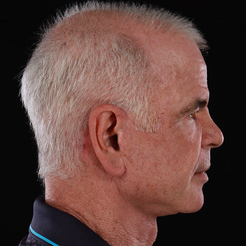 Facelift Before & After Gallery - Patient 424295 - Image 6