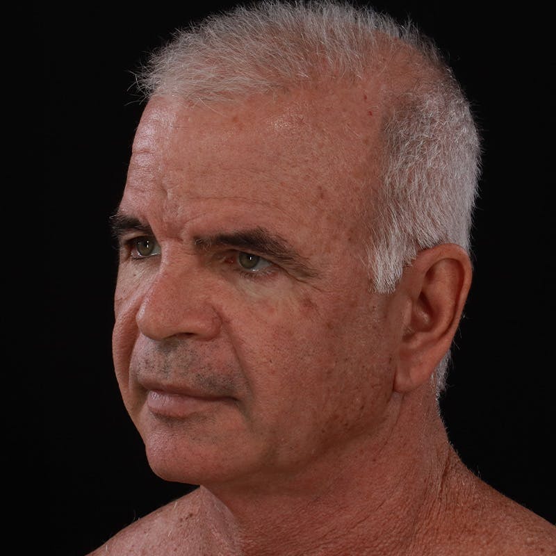 Facelift Before & After Gallery - Patient 424295 - Image 7