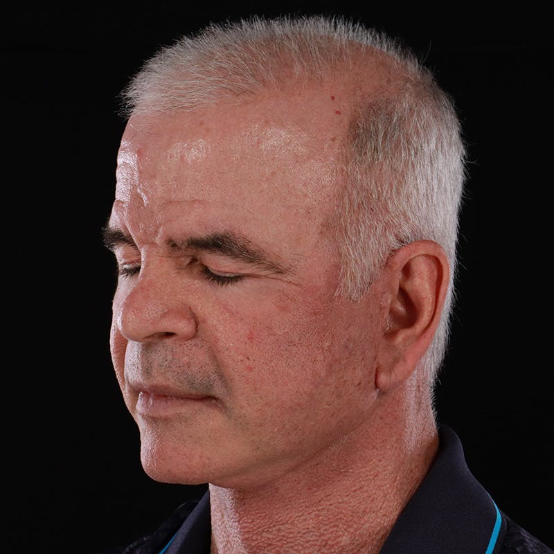 Facelift Before & After Gallery - Patient 424295 - Image 8
