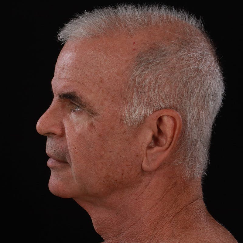 Facelift Before & After Gallery - Patient 424295 - Image 9